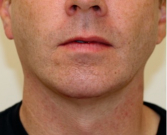 Feel Beautiful - Chin Implant 204 - After Photo